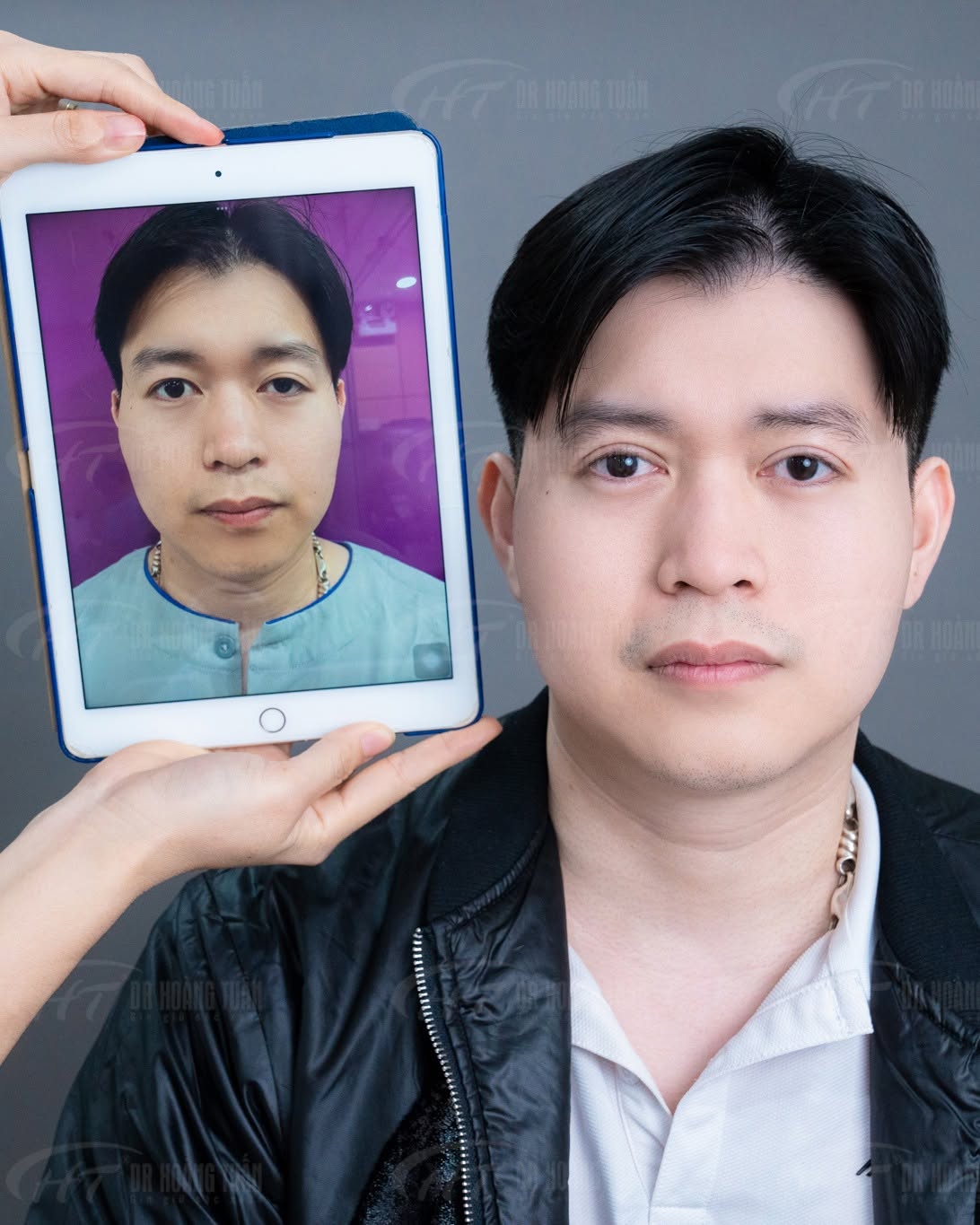 cắt m&iacute; mắt nam