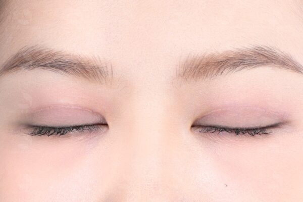 cắt m&iacute; bị sẹo trắng