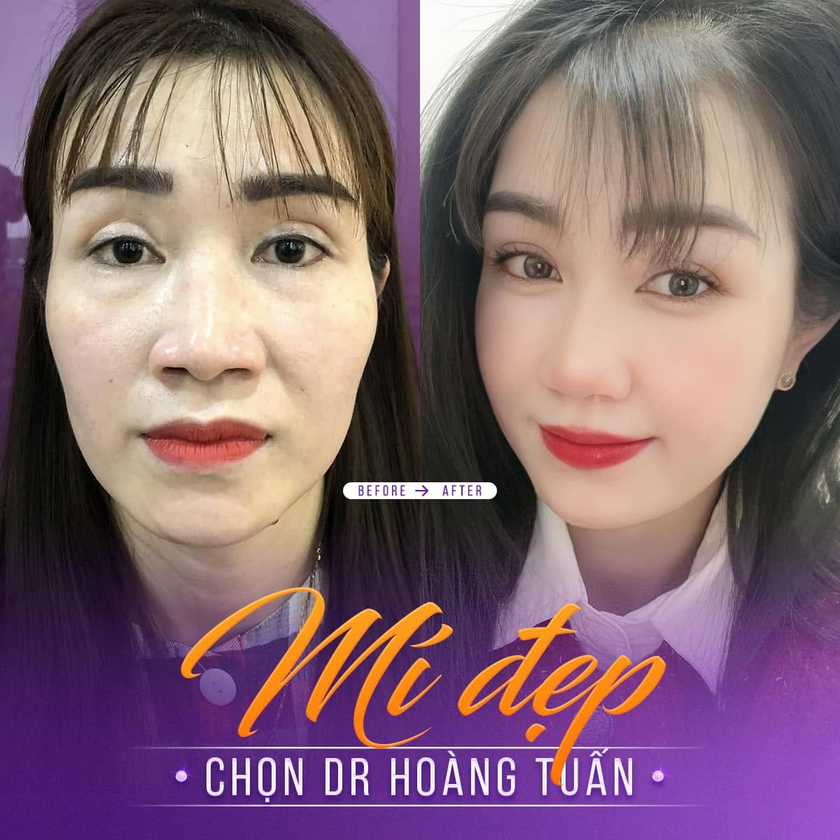 cắt mí dưới bị trợn