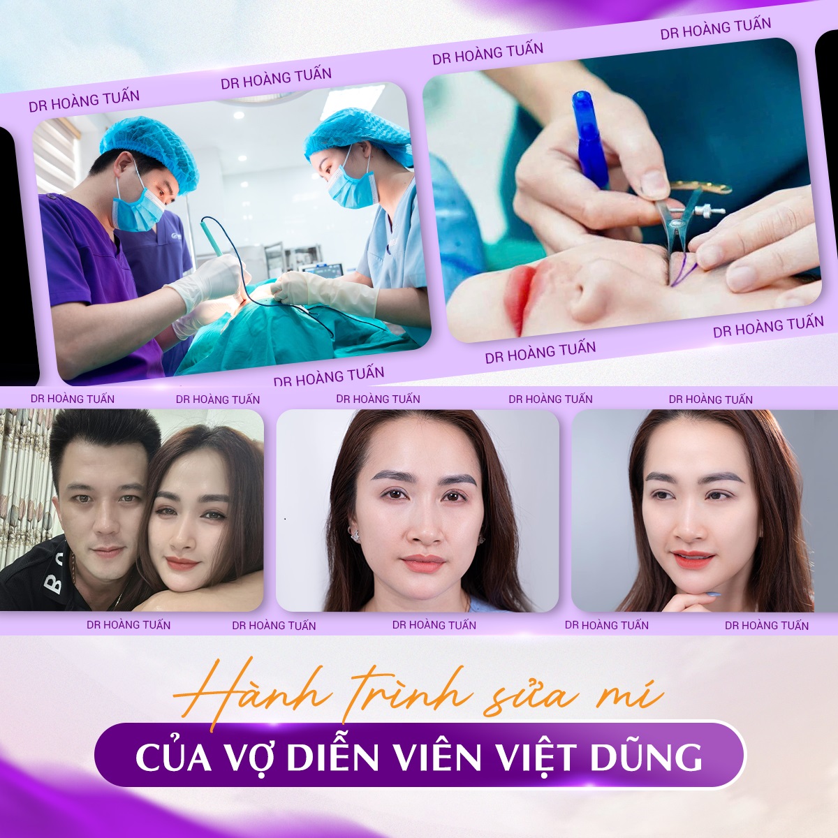 Hành trình sửa mí hỏng của vợ diễn viên Hà Việt Dũng