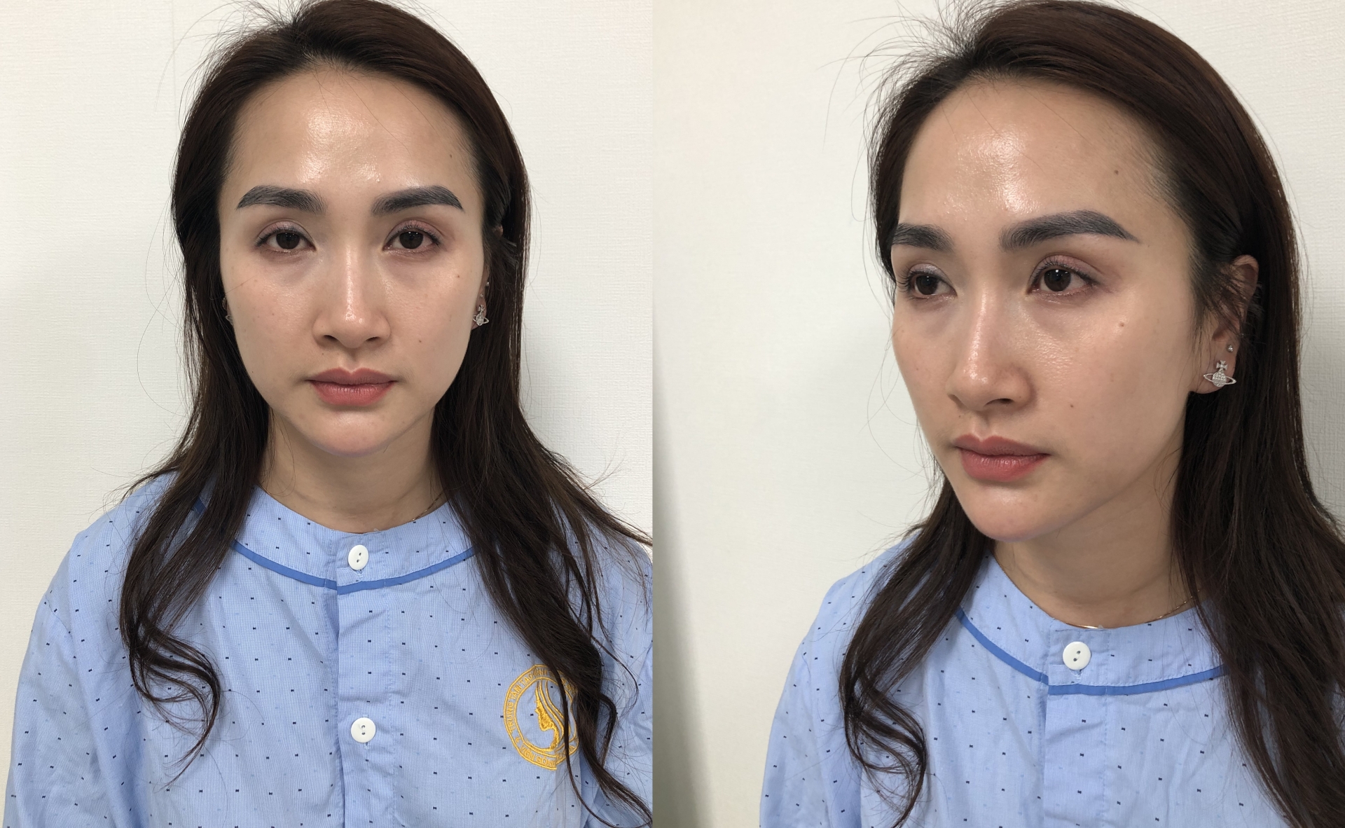 Tình trạng đôi mắt từng cắt mí lỗi của Hà Nhung