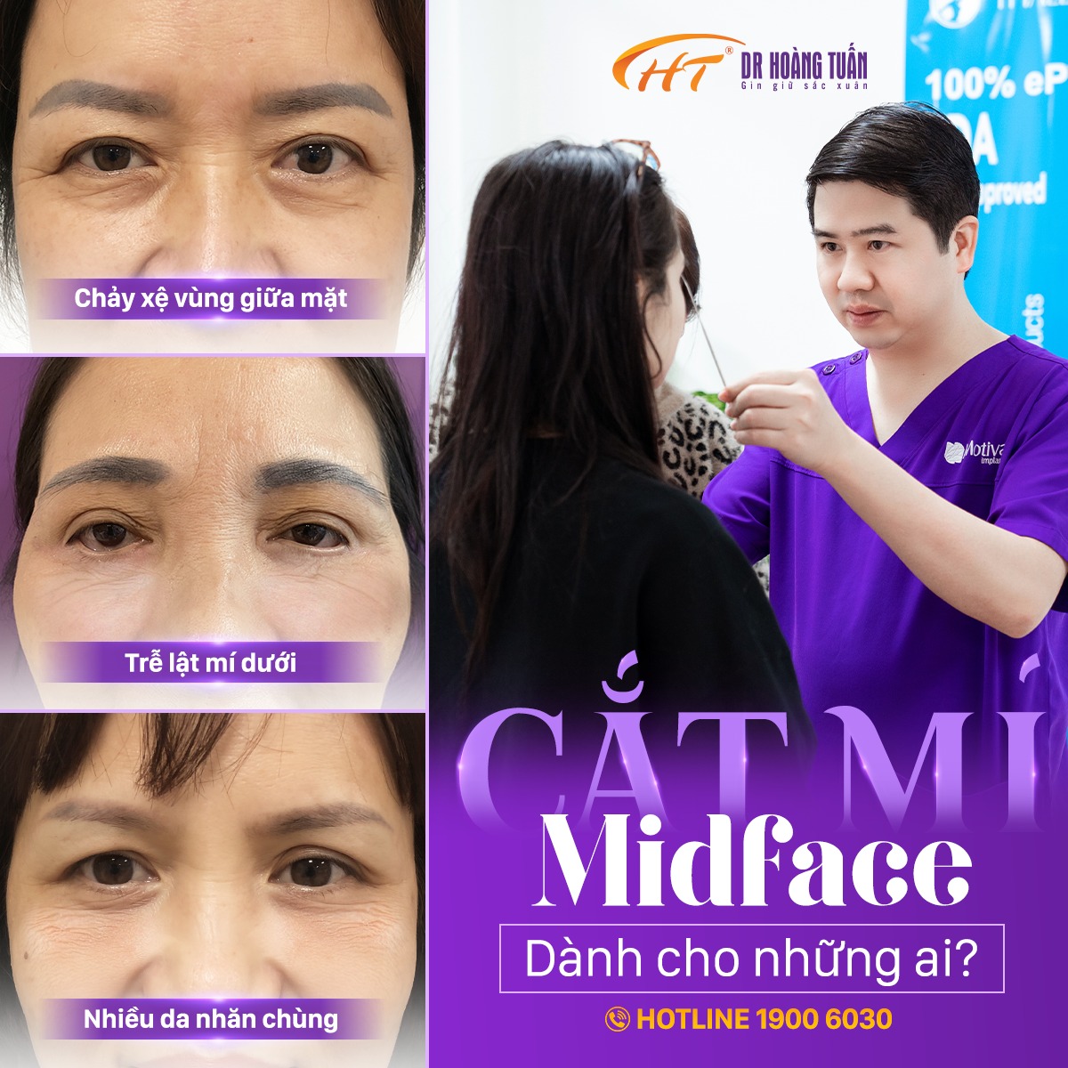 Cắt mí midface xử lý được nhiều khuyết điểm lão hóa phù hợp với nhiều trường hợp 