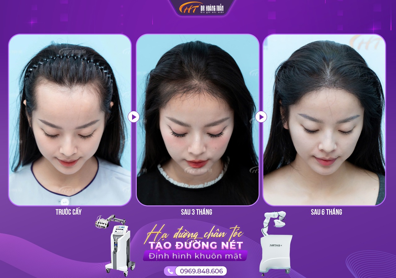 Hạ đường ch&acirc;n t&oacute;c