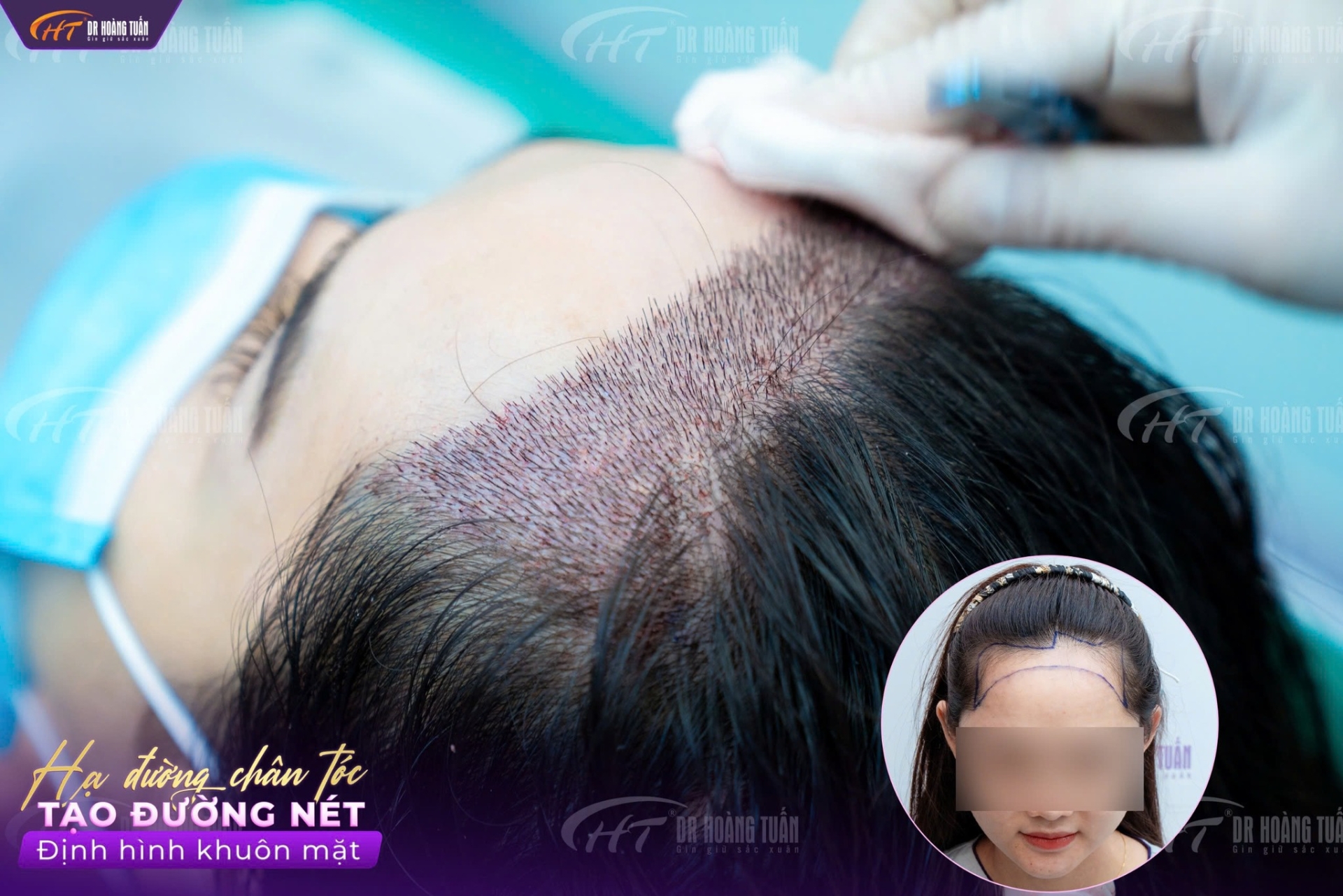 Hạ đường ch&acirc;n t&oacute;c