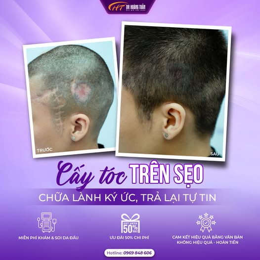 cấy t&oacute;c tr&ecirc;n sẹo