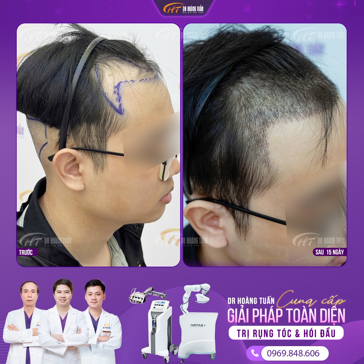 quy tr&igrave;nh cấy t&oacute;c tự th&acirc;n