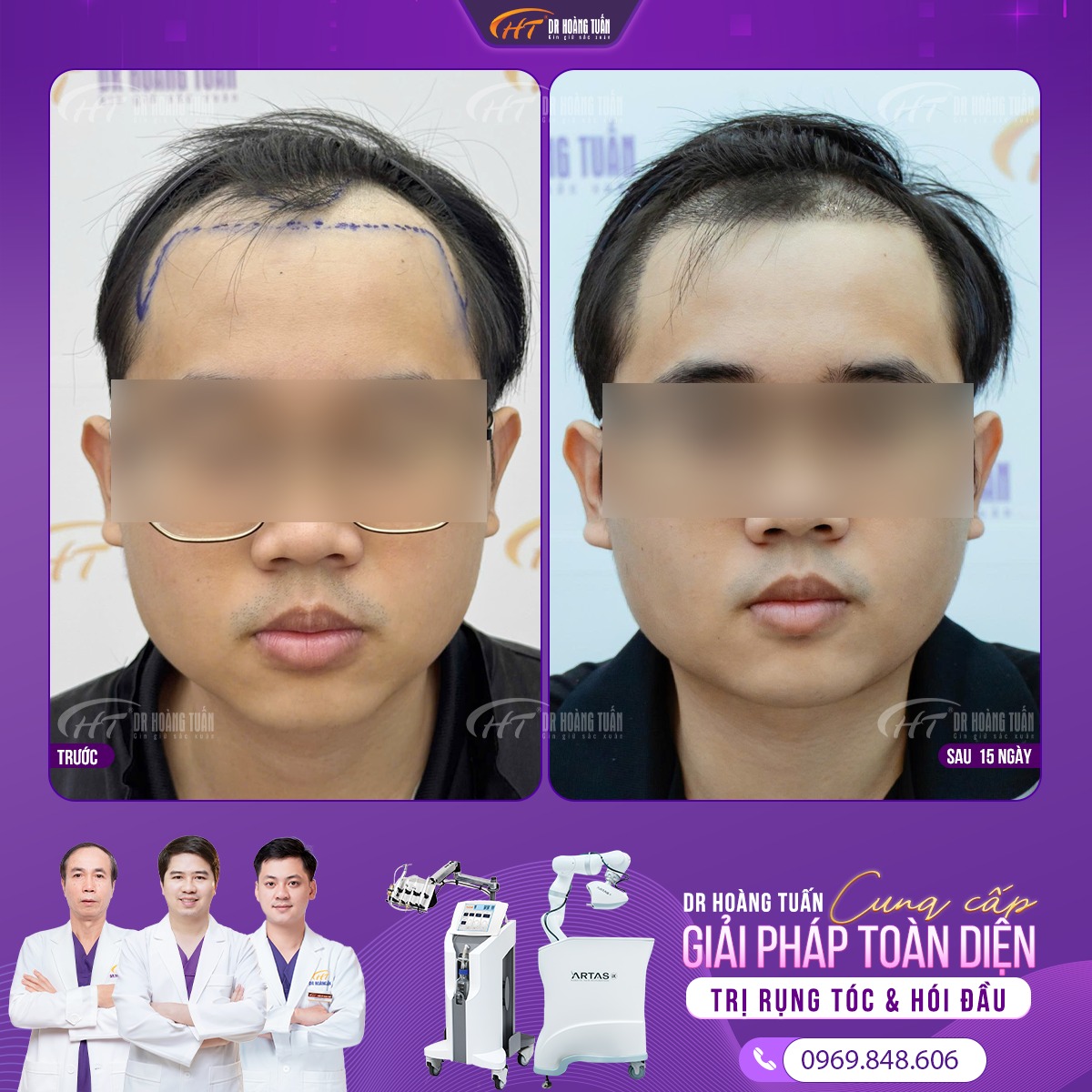 tr&aacute;n h&oacute;i chữ m