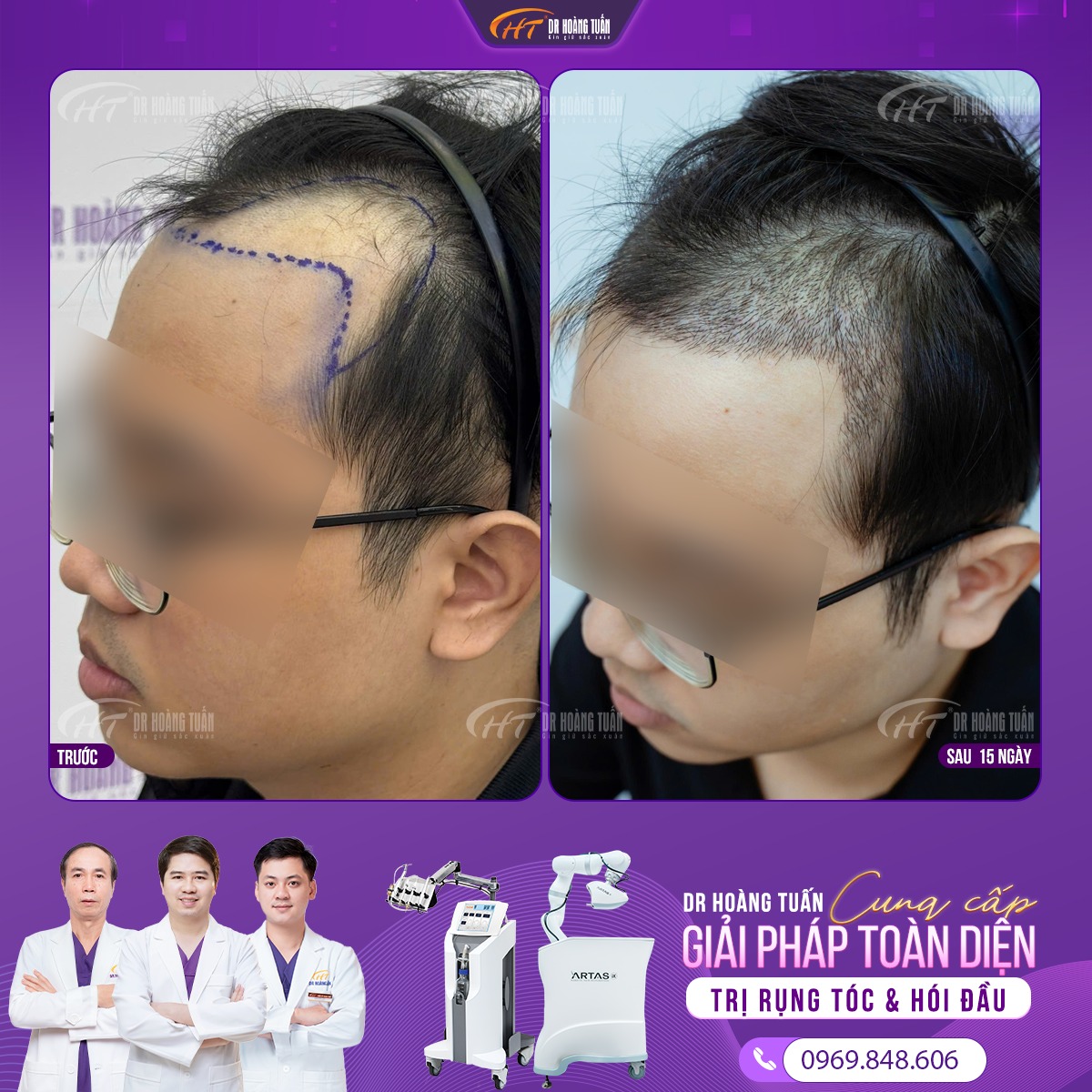 h&oacute;i chữ m do đ&acirc;u