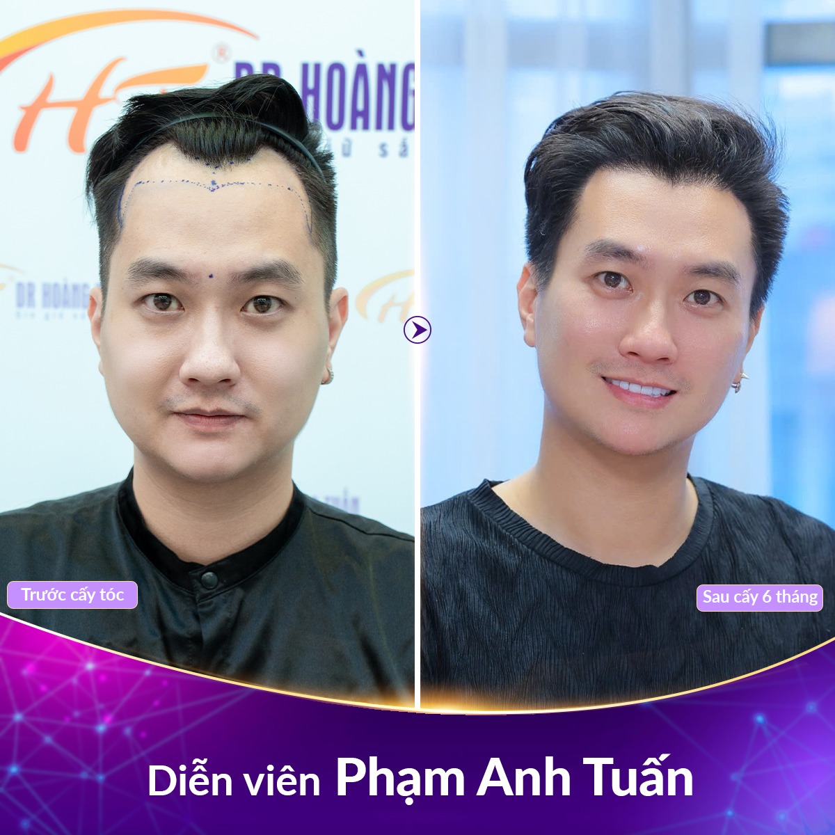 cấy t&oacute;c tự th&acirc;n c&oacute; hiệu quả kh&ocirc;ng