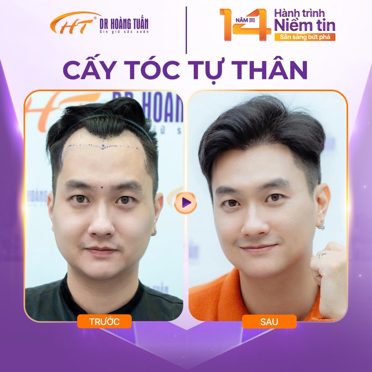 cấy t&oacute;c tự th&acirc;n gi&aacute; bao nhi&ecirc;u