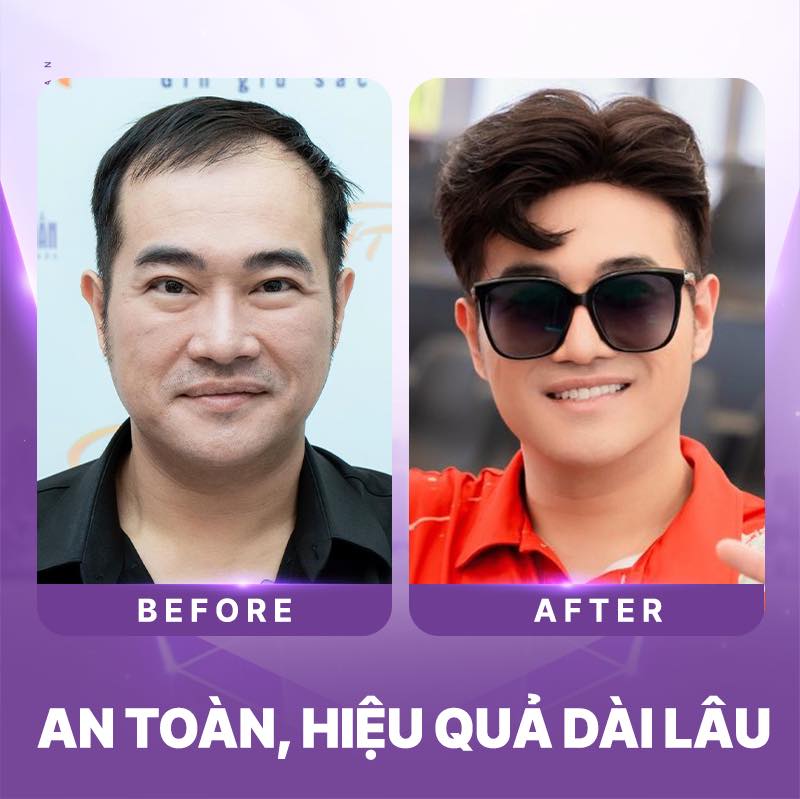 review cấy t&oacute;c tự th&acirc;n