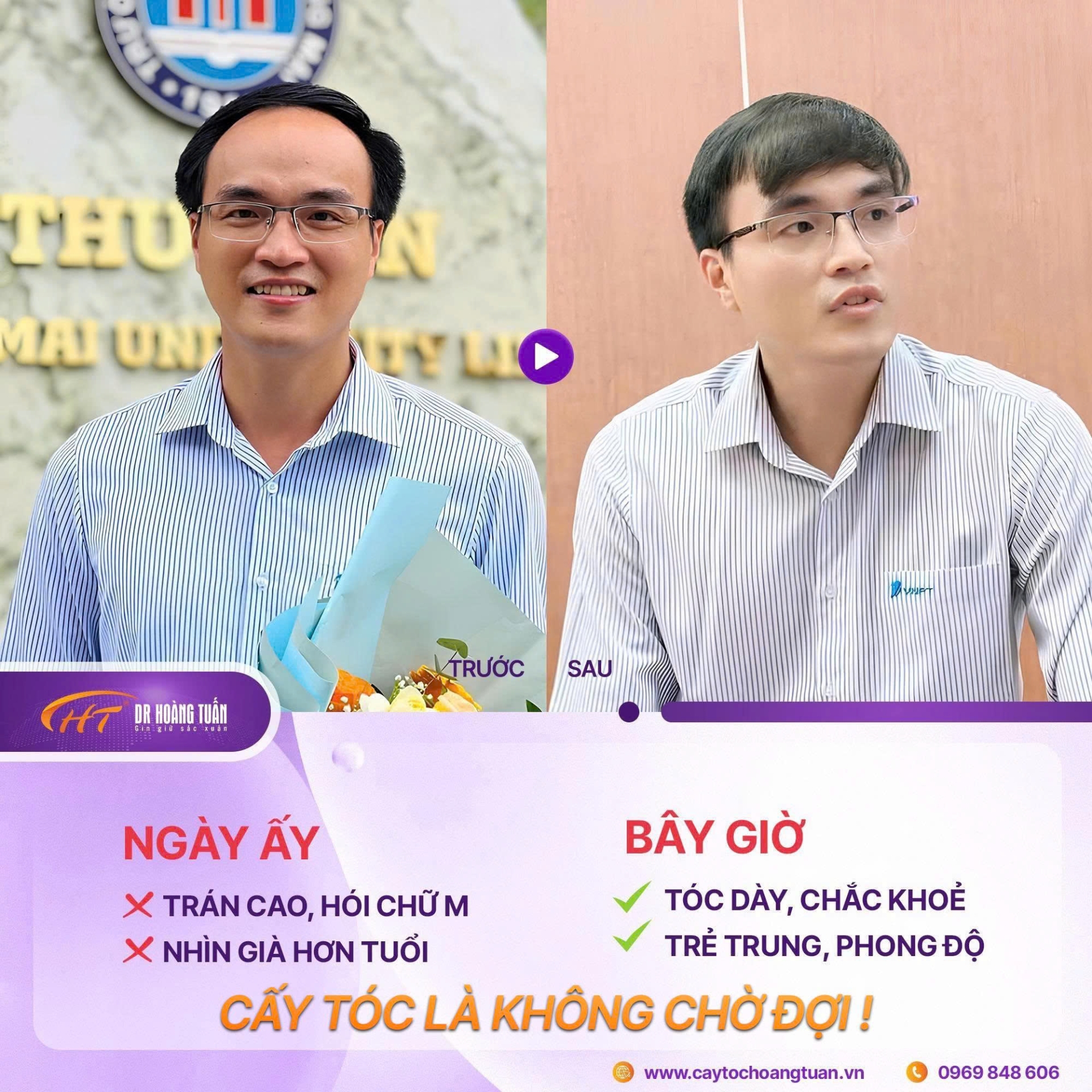 cấy t&oacute;c tự th&acirc;n được bao l&acirc;u