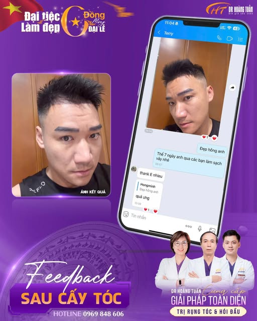 cấy t&oacute;c tự th&acirc;n c&oacute; tốt kh&ocirc;ng