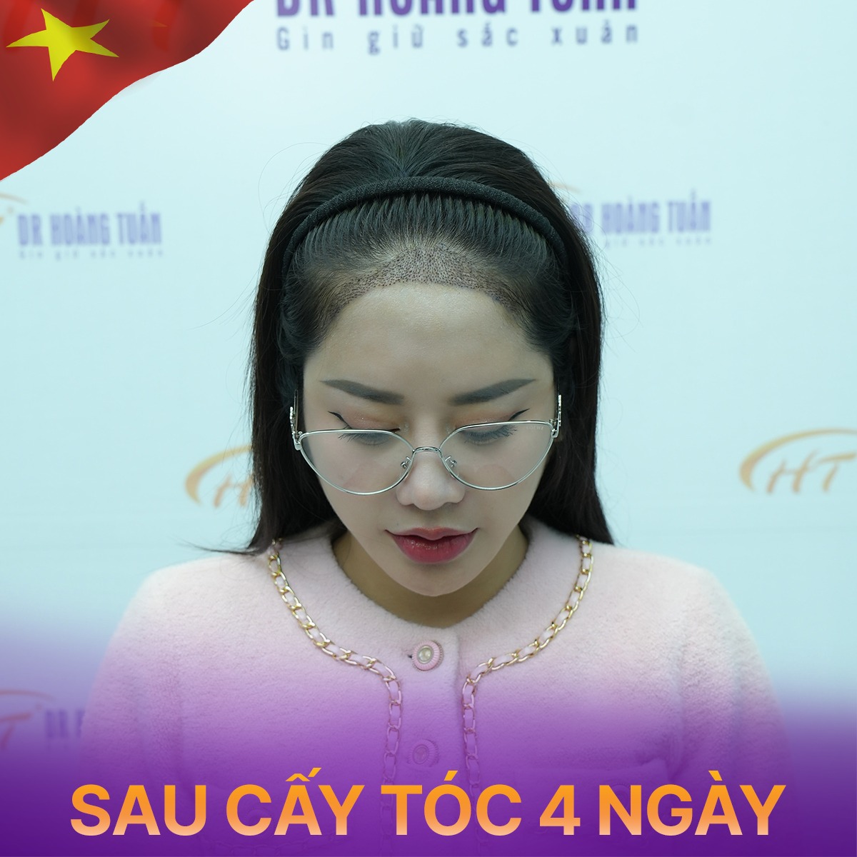 cấy t&oacute;c tự th&acirc;n mất bao l&acirc;u