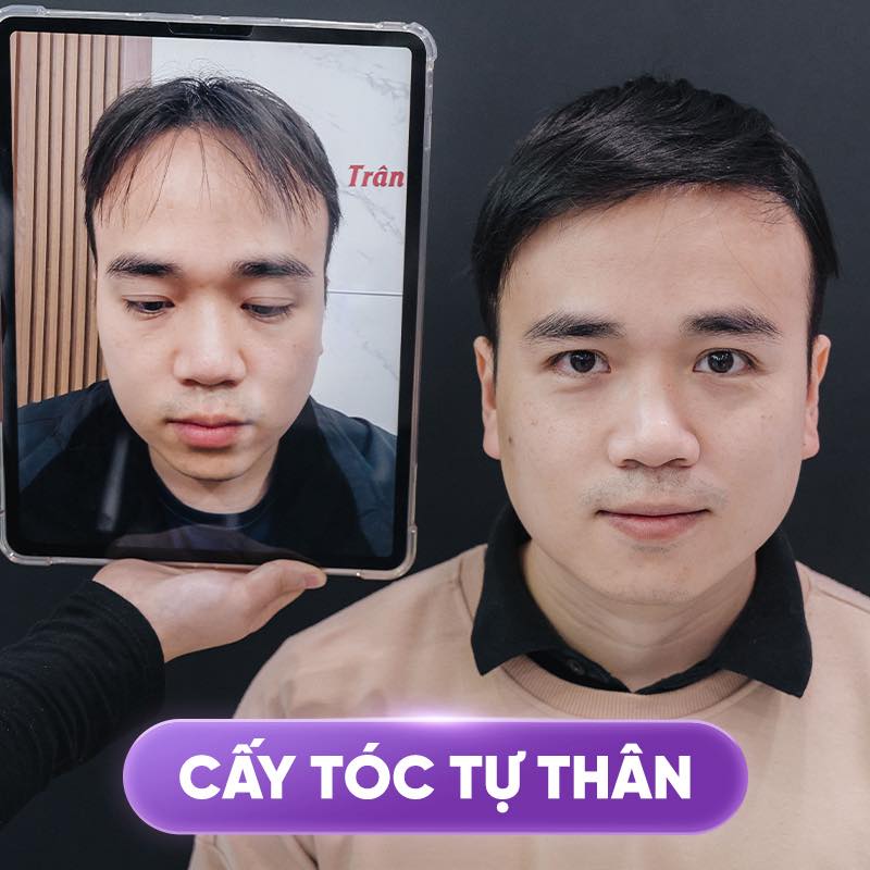 review cấy t&oacute;c tự th&acirc;n