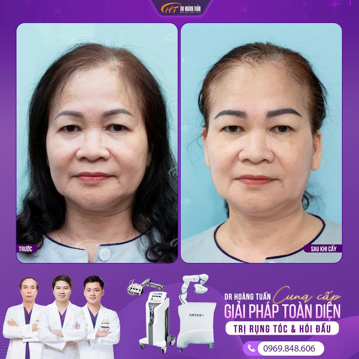 cấy l&ocirc;ng m&agrave;y