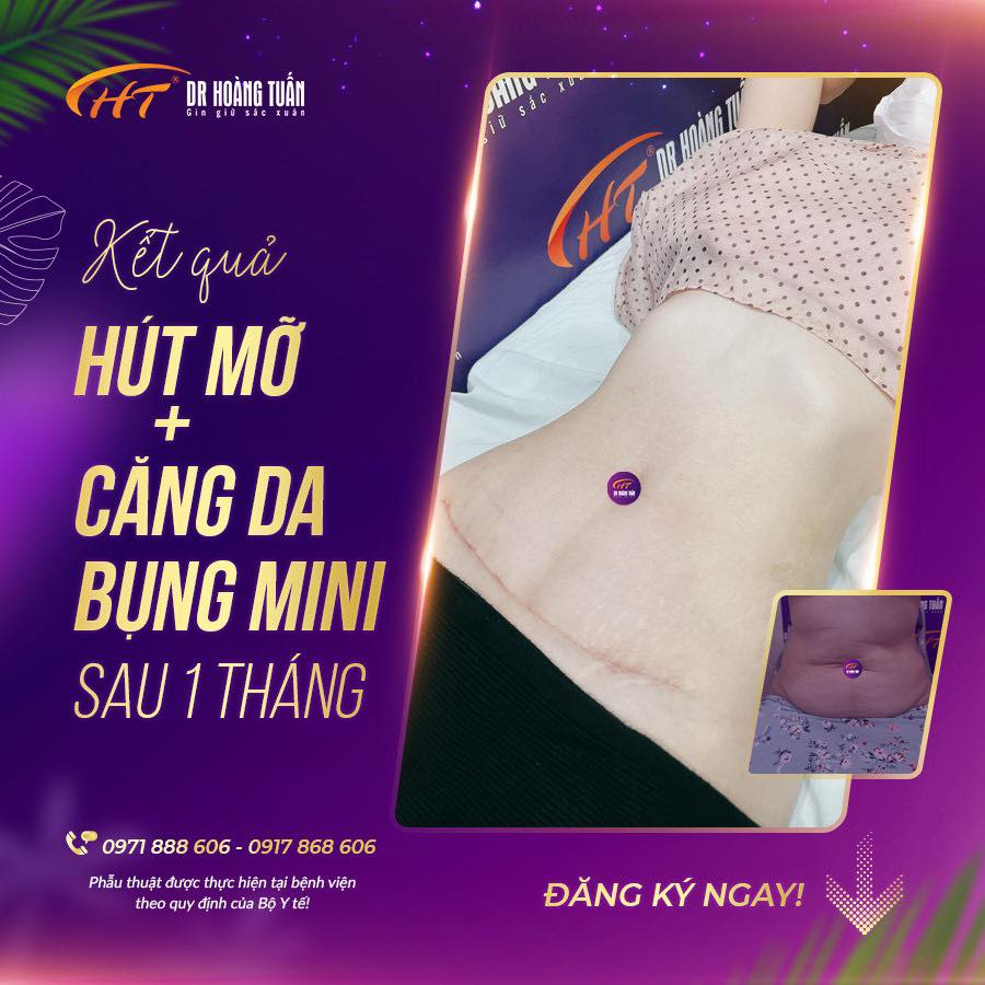 Kết quả căng da bụng mini tại Dr Hoàng Tuấn