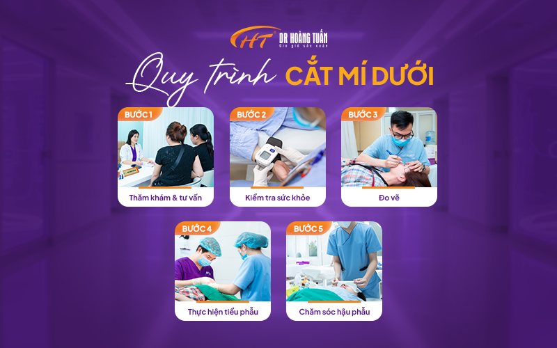 Cắt mí dưới tại Dr Hoàng Tuấn