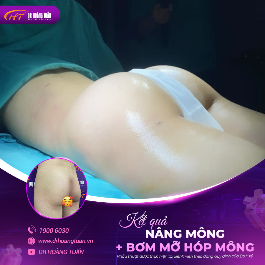 Kết quả cấy mỡ mông tại Dr Hoàng Tuấn