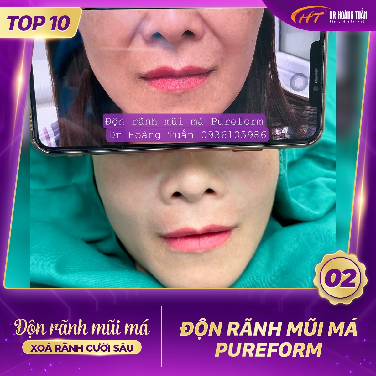 Hình ảnh kết quả độn rãnh mũi má tại Dr Hoàng Tuấn