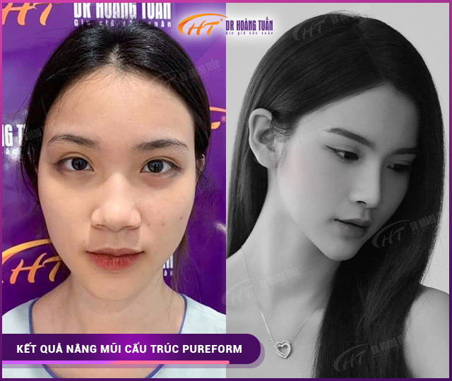 Hình ảnh kết quả nâng mũi cấu trúc pureform tại Dr Hoàng Tuấn