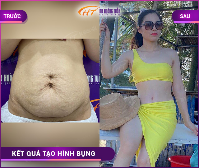 kết quả tạo hình thành bụng tại Dr Hoàng Tuấn