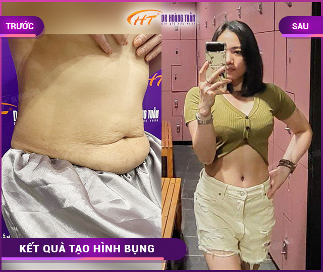 kết quả tạo hình thành bụng tại Dr Hoàng Tuấn