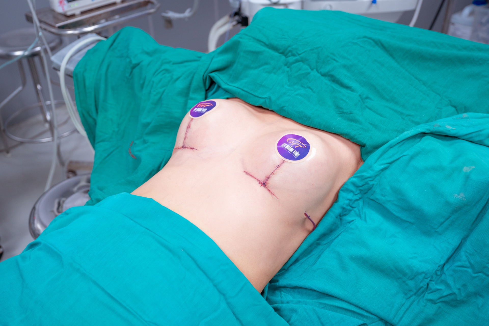 Hình ảnh khách hàng treo sa trễ tại Dr Hoàng Tuấn 