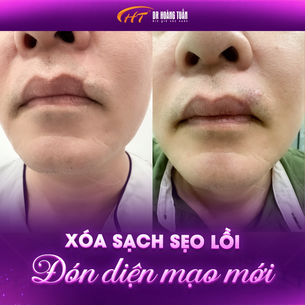 Hình ảnh kết quả xóa sẹo tại Dr Hoàng Tuấn