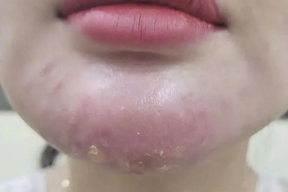 độn cằm hỏng