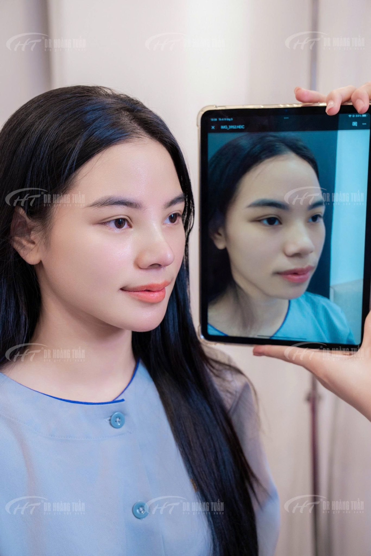 độn cằm bằng chất liệu g&igrave;