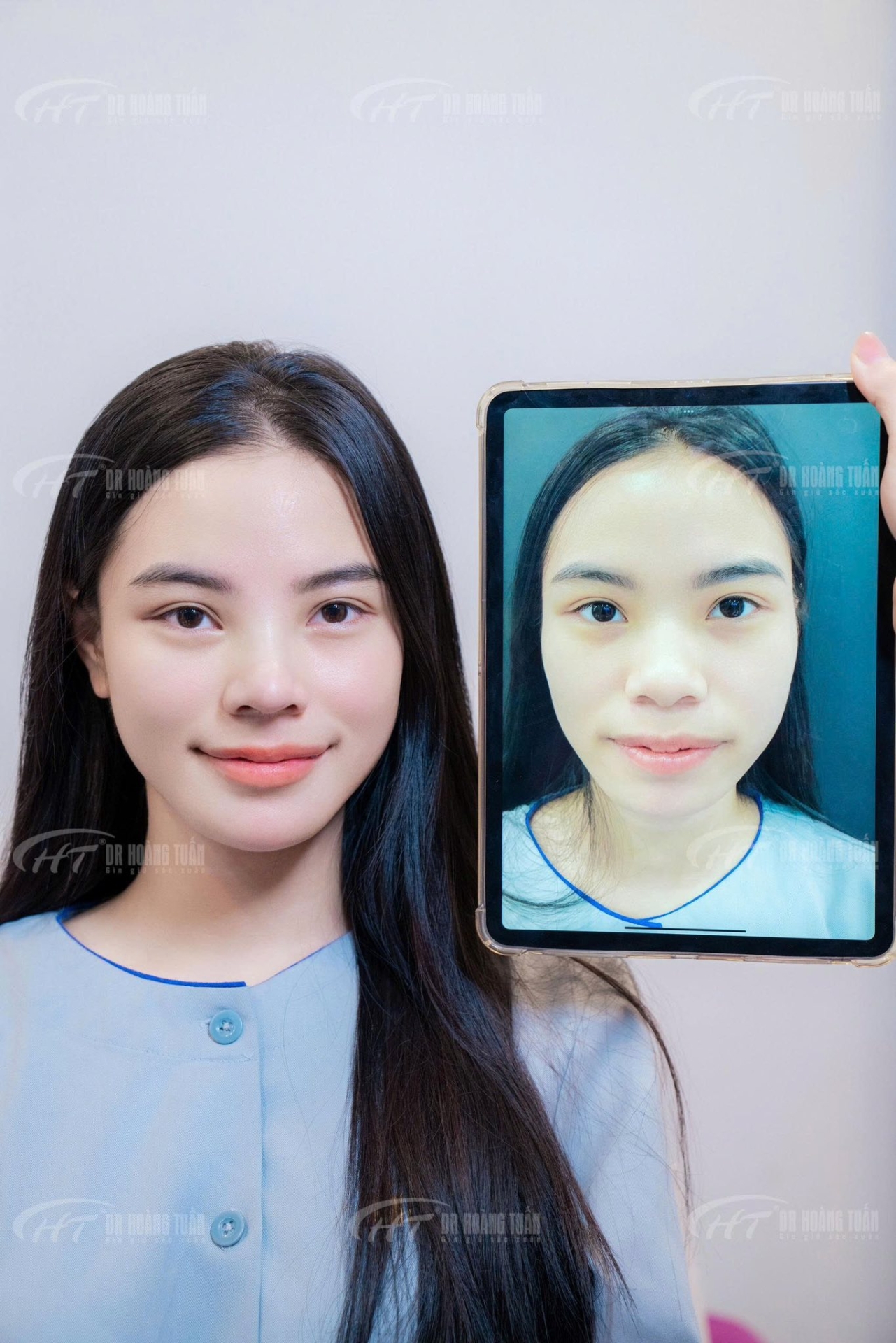 độn cằm hỏng