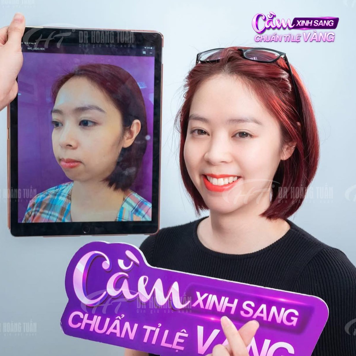 độn cằm có hại không