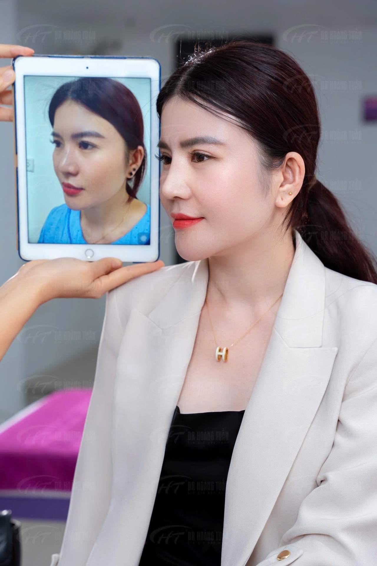 độn cằm c&oacute; được vĩnh viễn kh&ocirc;ng