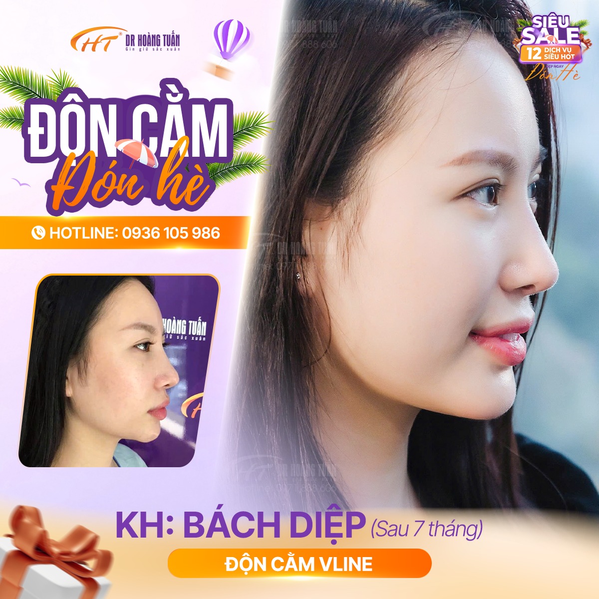 độn cằm c&oacute; hết h&ocirc; kh&ocirc;ng