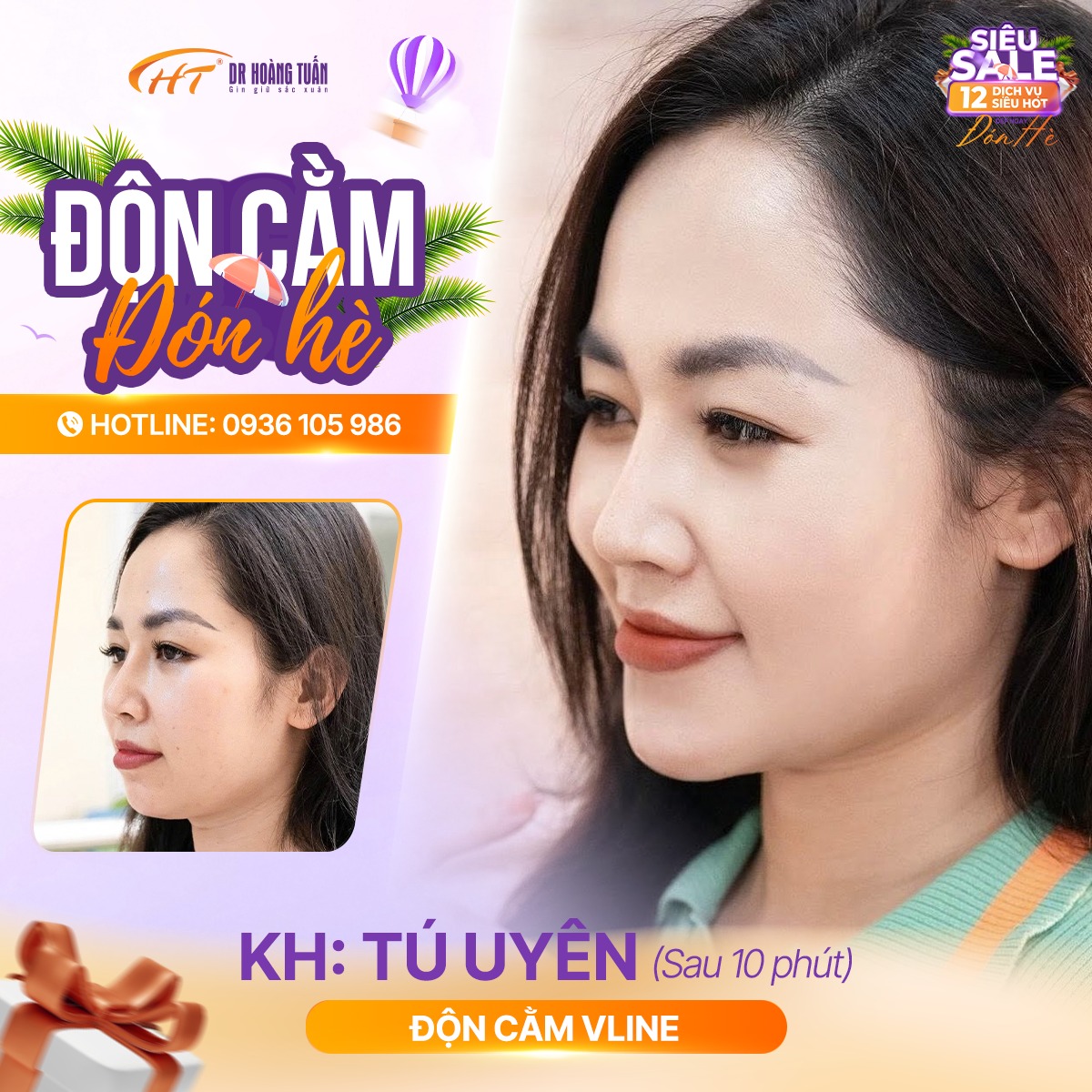 độn cằm c&oacute; dễ bị lệch kh&ocirc;ng
