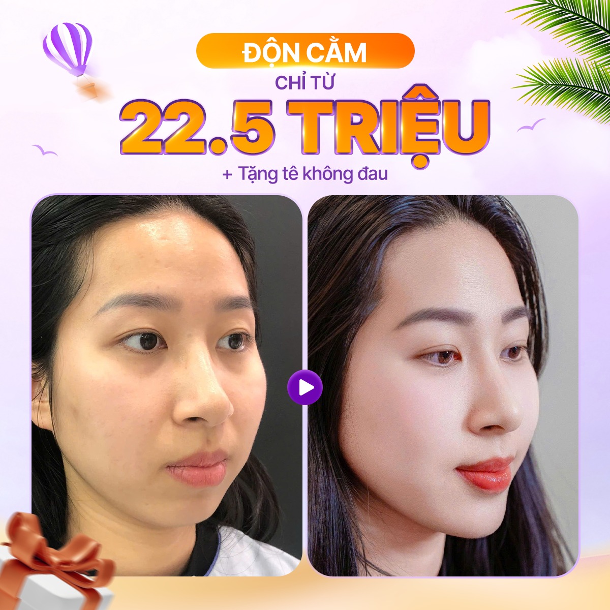 độn cằm bao nhi&ecirc;u tiền