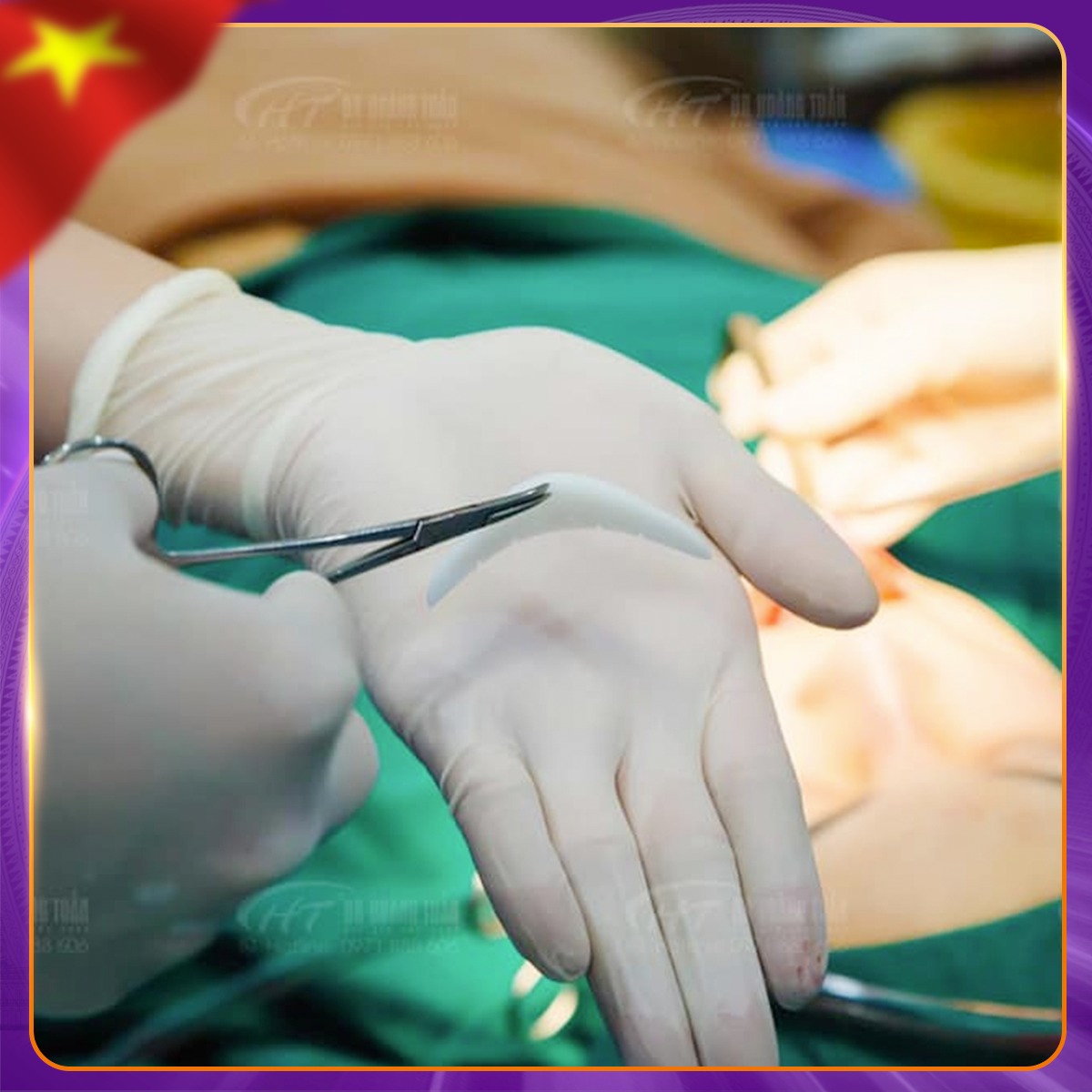 độn cằm bằng chất liệu g&igrave;