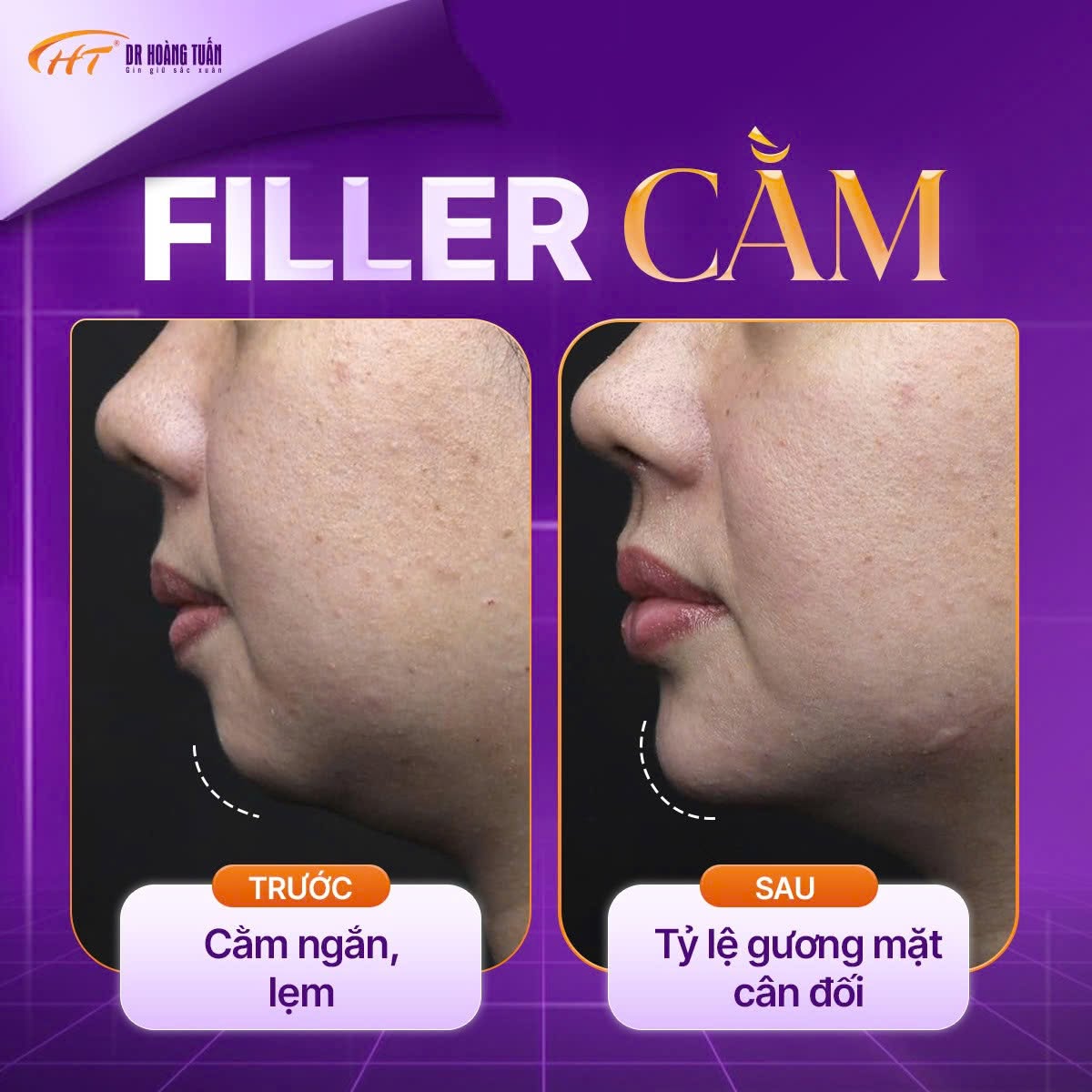 so s&aacute;nh độn cằm v&agrave; ti&ecirc;m filler