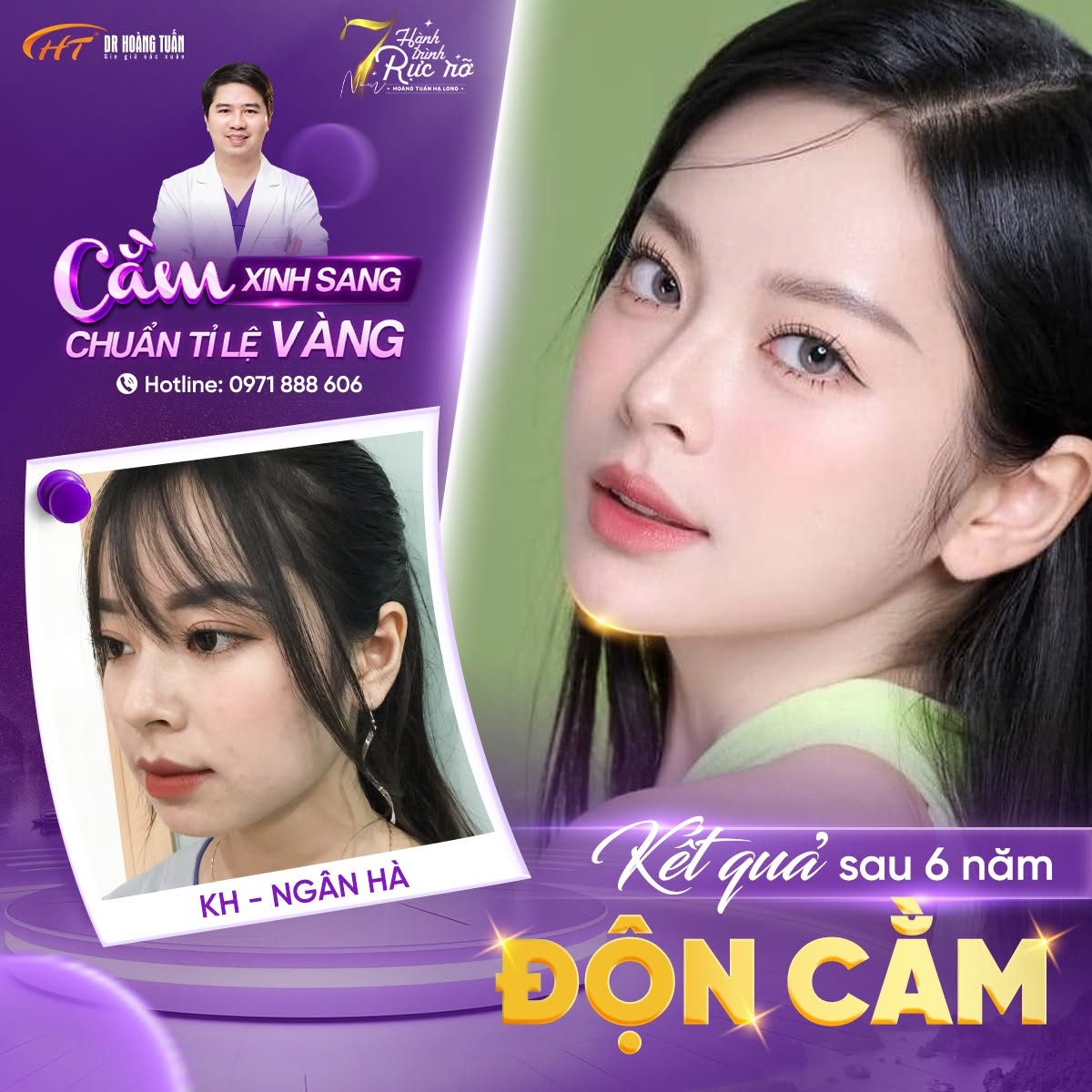 so s&aacute;nh độn cằm v&agrave; ti&ecirc;m filler