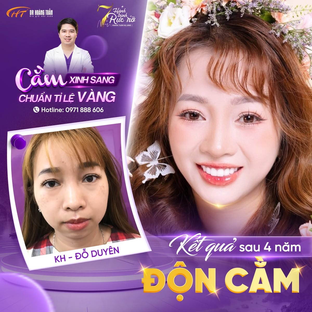 độn cằm c&oacute; được vĩnh viễn kh&ocirc;ng