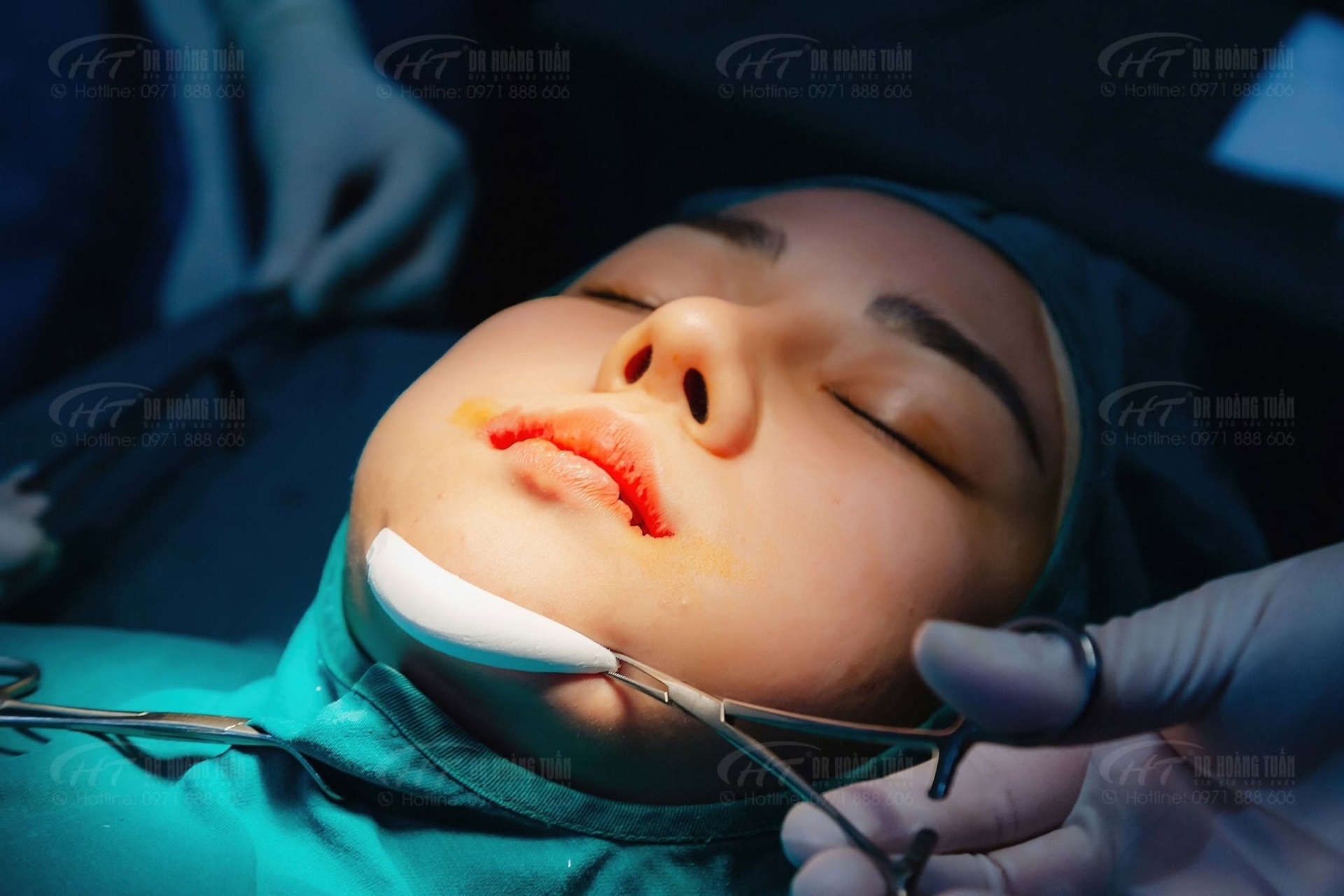 độn cằm c&oacute; dễ bị lệch kh&ocirc;ng
