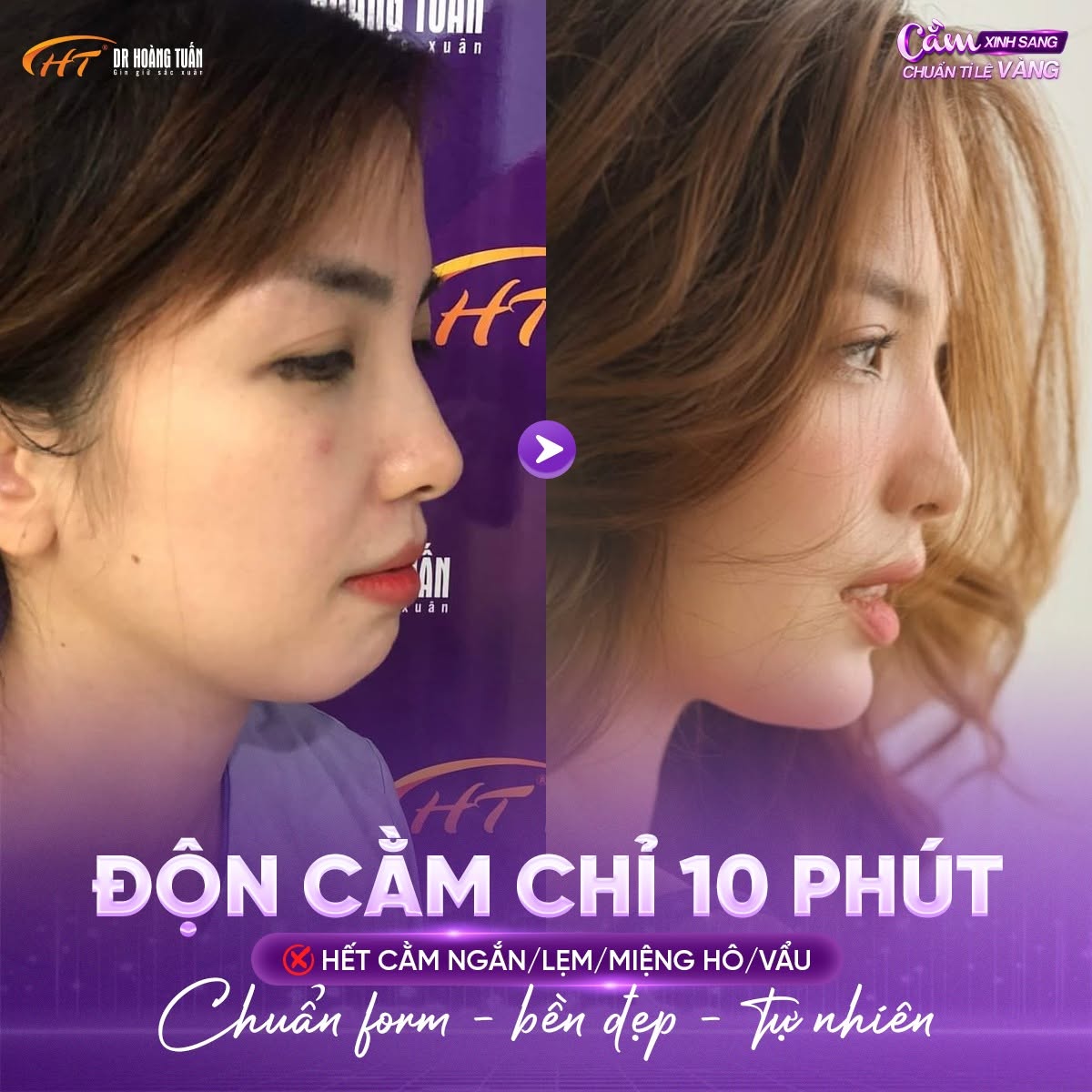 độn cằm lẹm