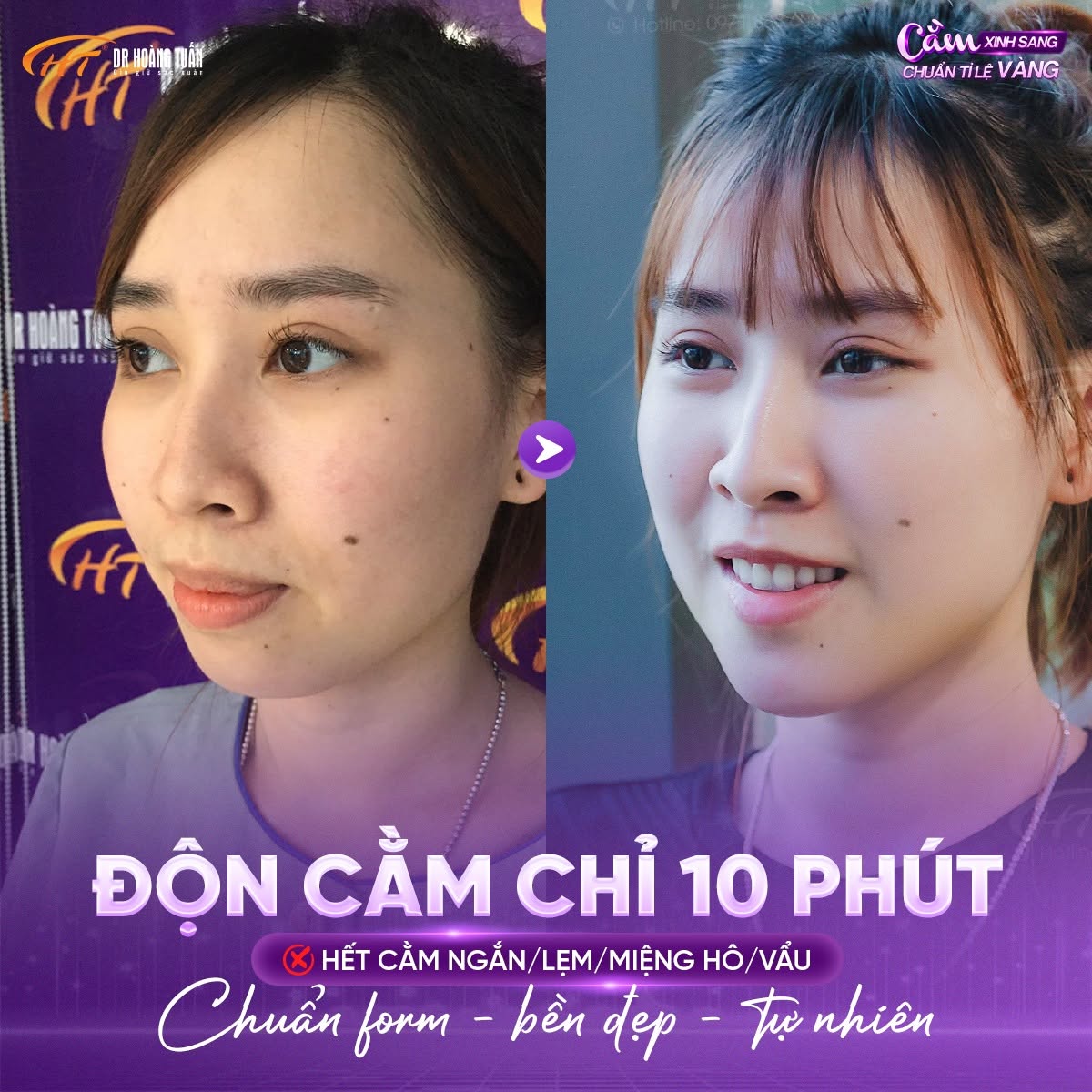 độn cằm lẹm