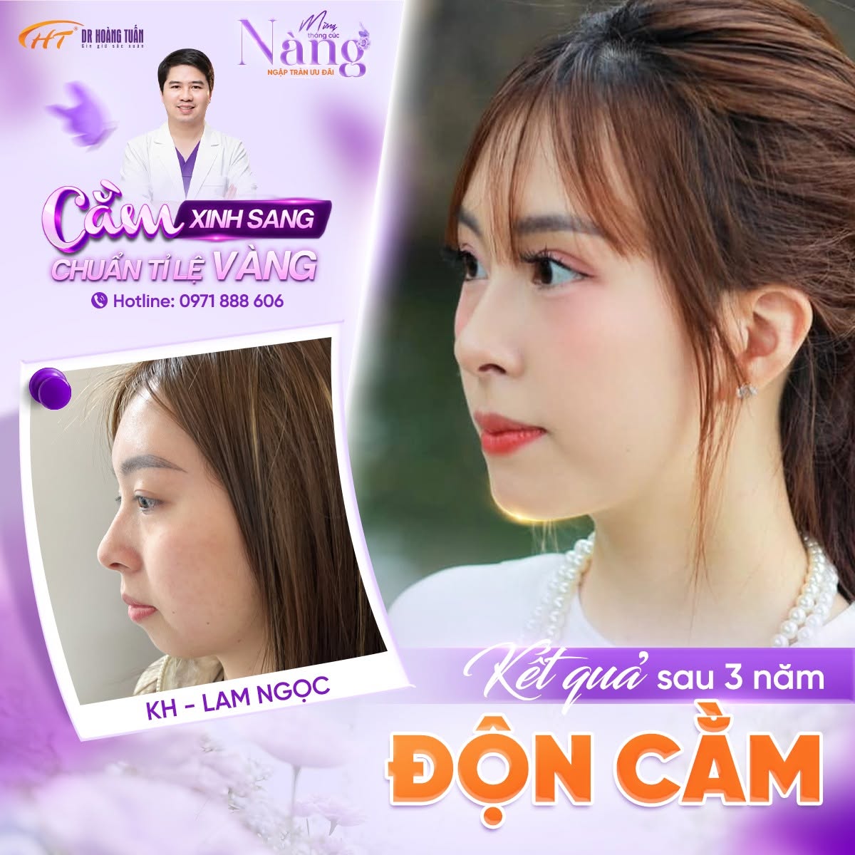 Sửa cằm lẹm