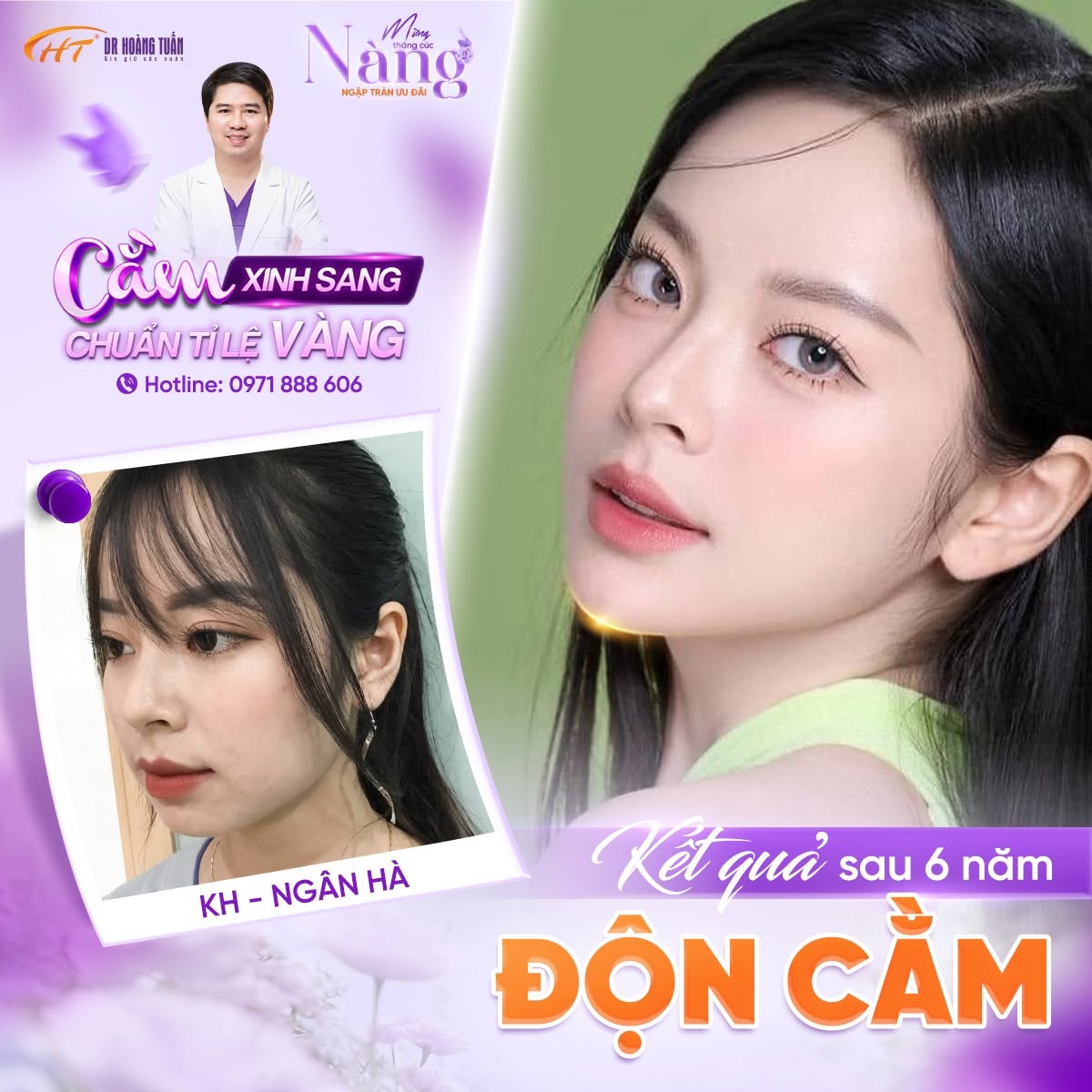 Sửa cằm lẹm
