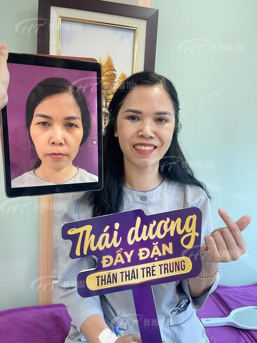 Độn th&aacute;i dương bao l&acirc;u hết sưng