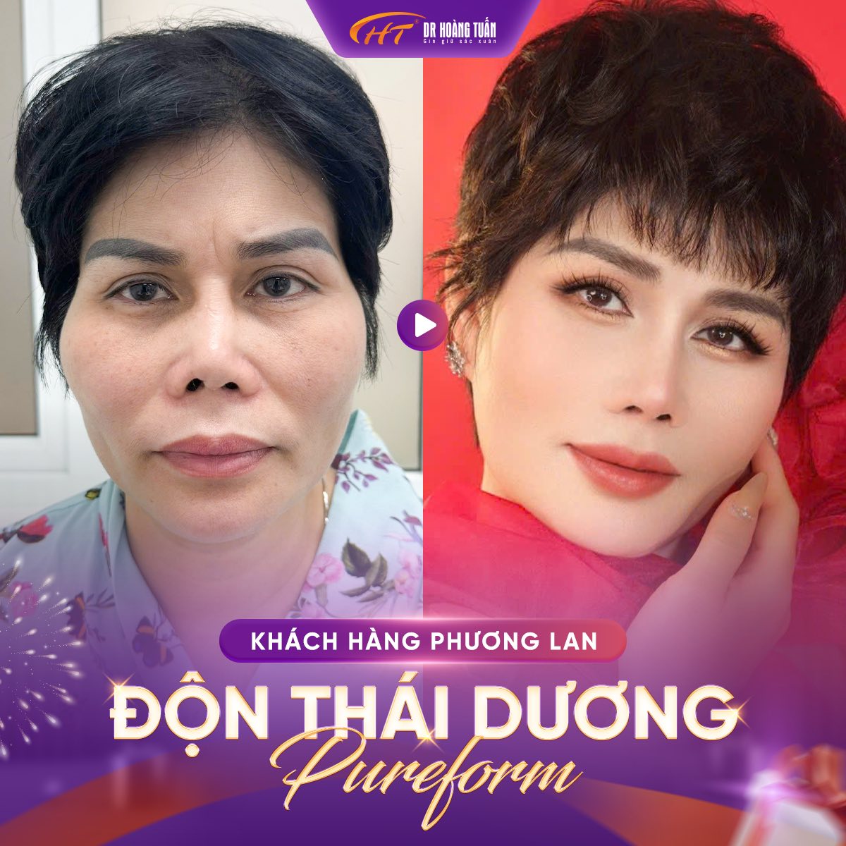 độn th&aacute;i dương gi&aacute; bao nhi&ecirc;u