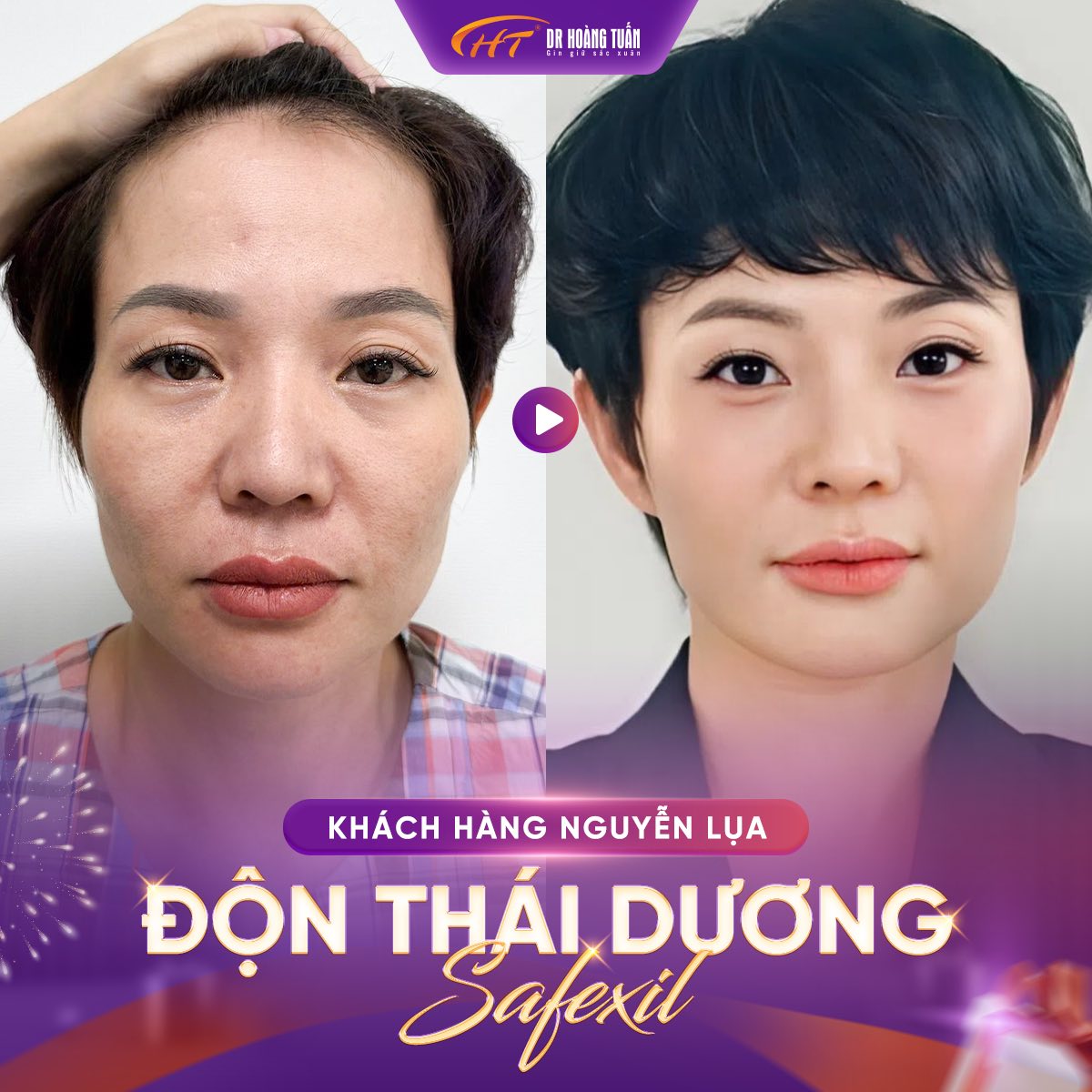 độn th&aacute;i dương bị lệch