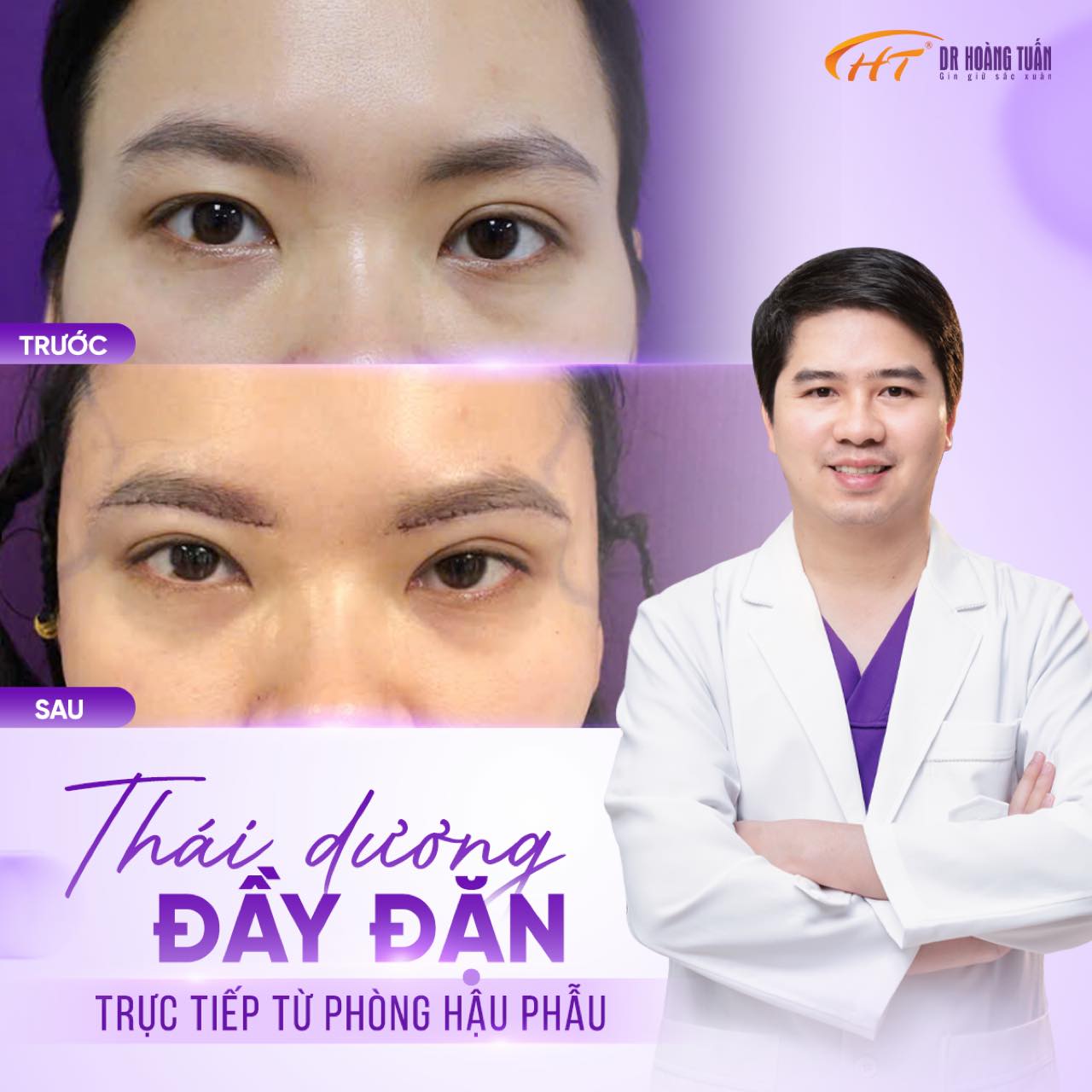 Độn th&aacute;i dương bao l&acirc;u hết sưng